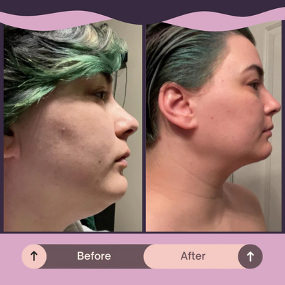 LumaLift™ Jawline Strap