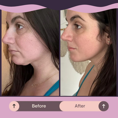 LumaLift™ Jawline Strap